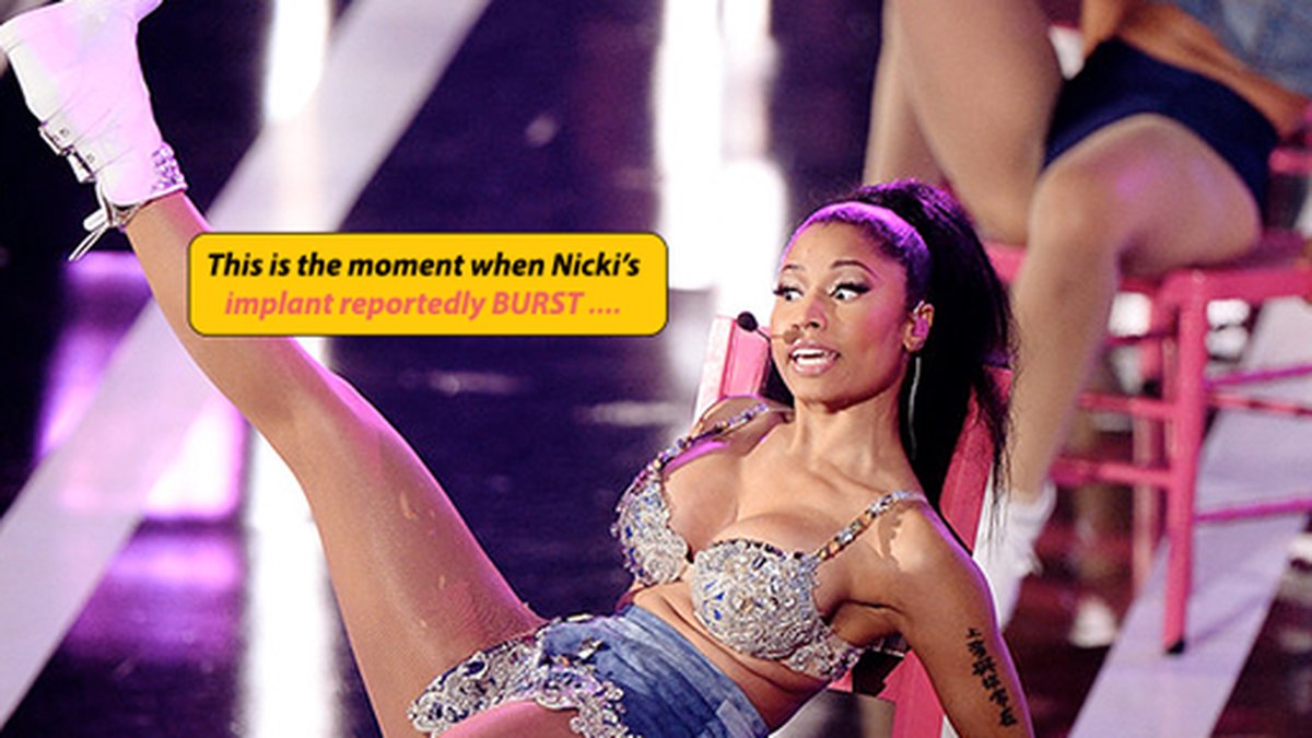 Nicki Minajs implantat sprack på scen. 